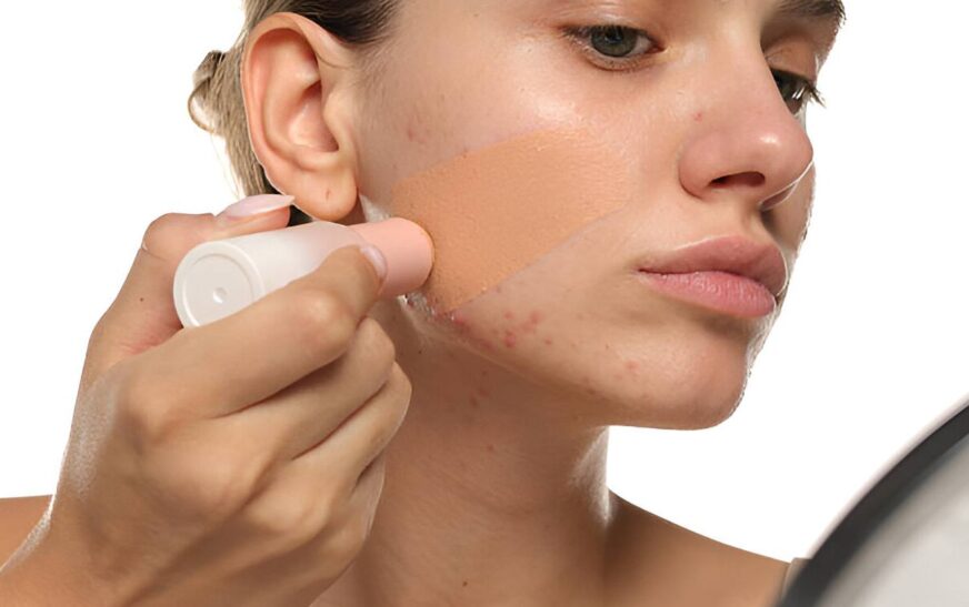 best foundation for acne prone skin