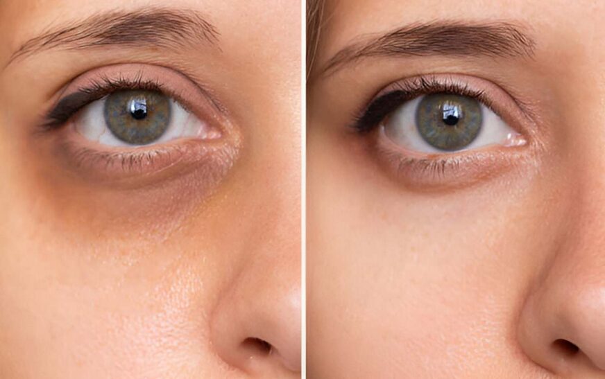 how to get rid of lines under eyes