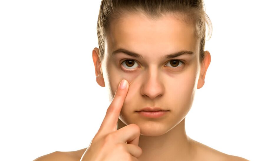 Remove Dark Circles Under Eyes Permanently in 30 Days: 5 Game-Changing Methods That Actually Work