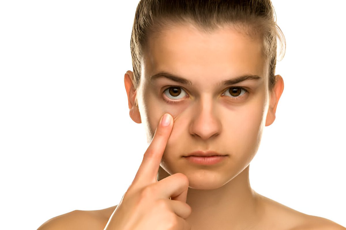 Remove Dark Circles Under Eyes Permanently in 30 Days: 5 Game-Changing Methods That Actually Work